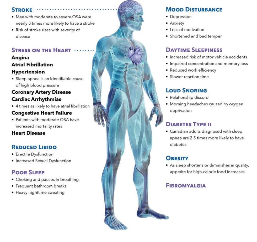 Home Sleep Apnea Testing - Obstructive Sleep Apnea Calgary